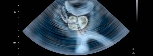 Biopsia de próstata (transrectal y transperineal)